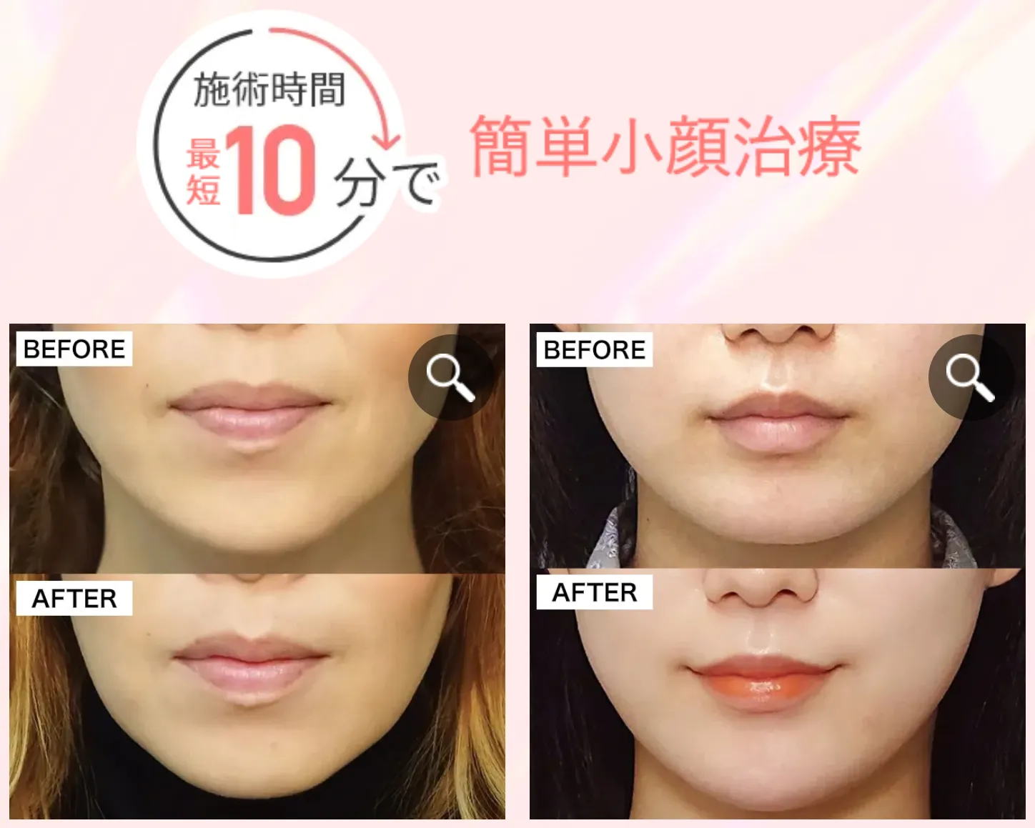 TCBのエラボトックスは最短約10分で施術が完了