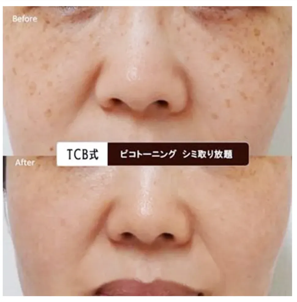 TCB ピコレーザー 症例写真