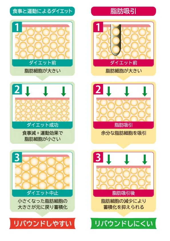 モニターで無料で受けられる脂肪吸引の特徴