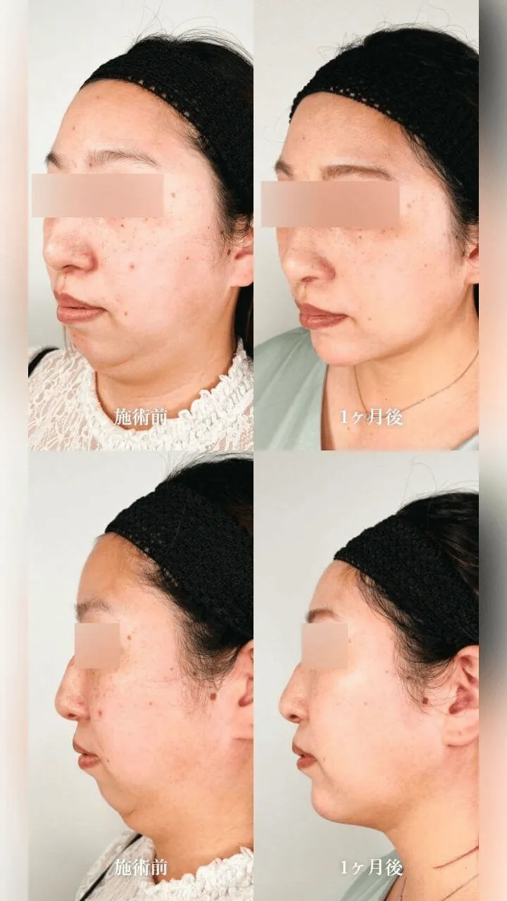 当記事一押しのTCBの脂肪吸引の症例写真