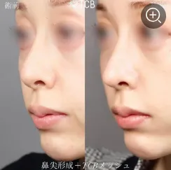 メッシュ鼻整形の症例③ 女性