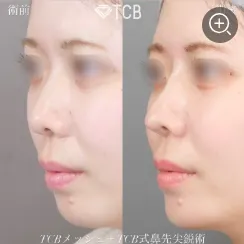 メッシュ鼻整形の症例④ 女性