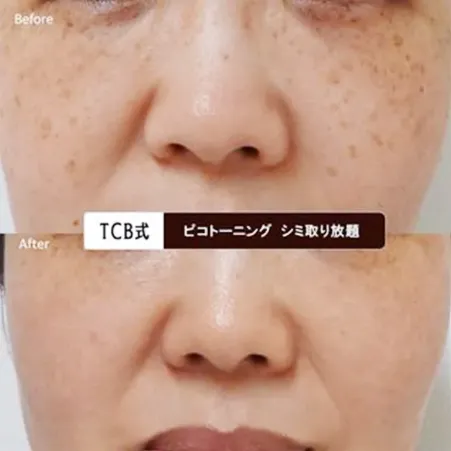 TCBのピコレーザー症例②
