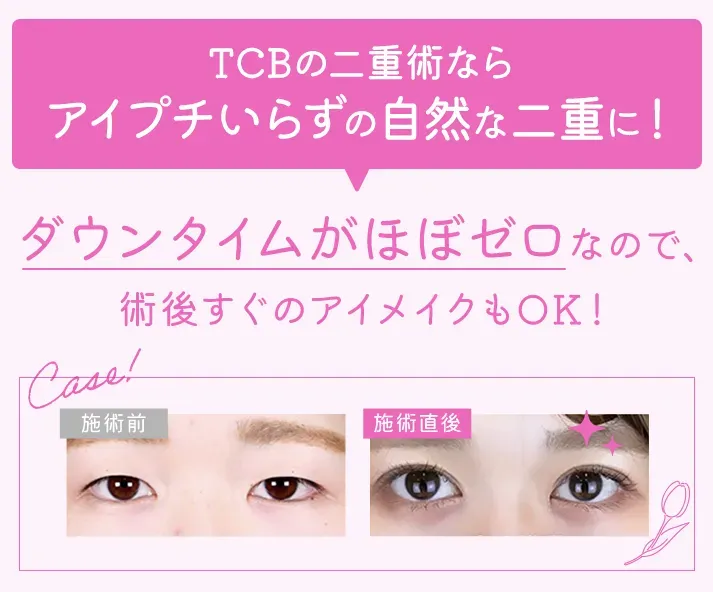 TCBの二重整形はダウンタイムがほぼゼロで自然な二重に