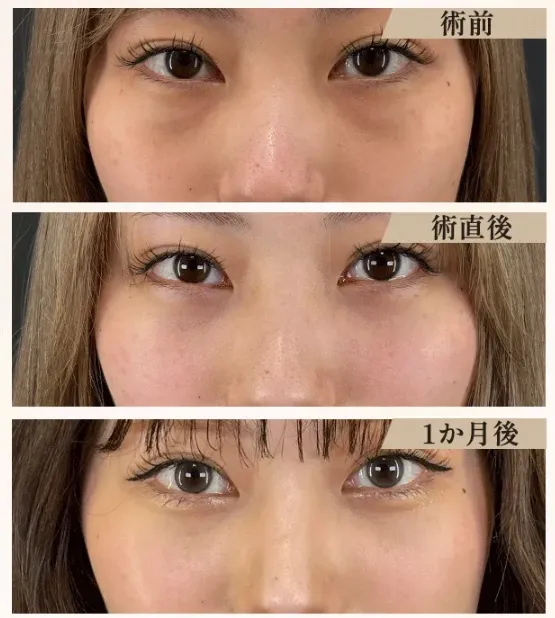 Tクリニック横浜院の口コミ評判｜切らない黄金比クマ取りの症例写真