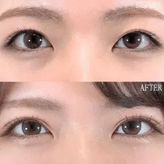 TCBの二重整形の症例
