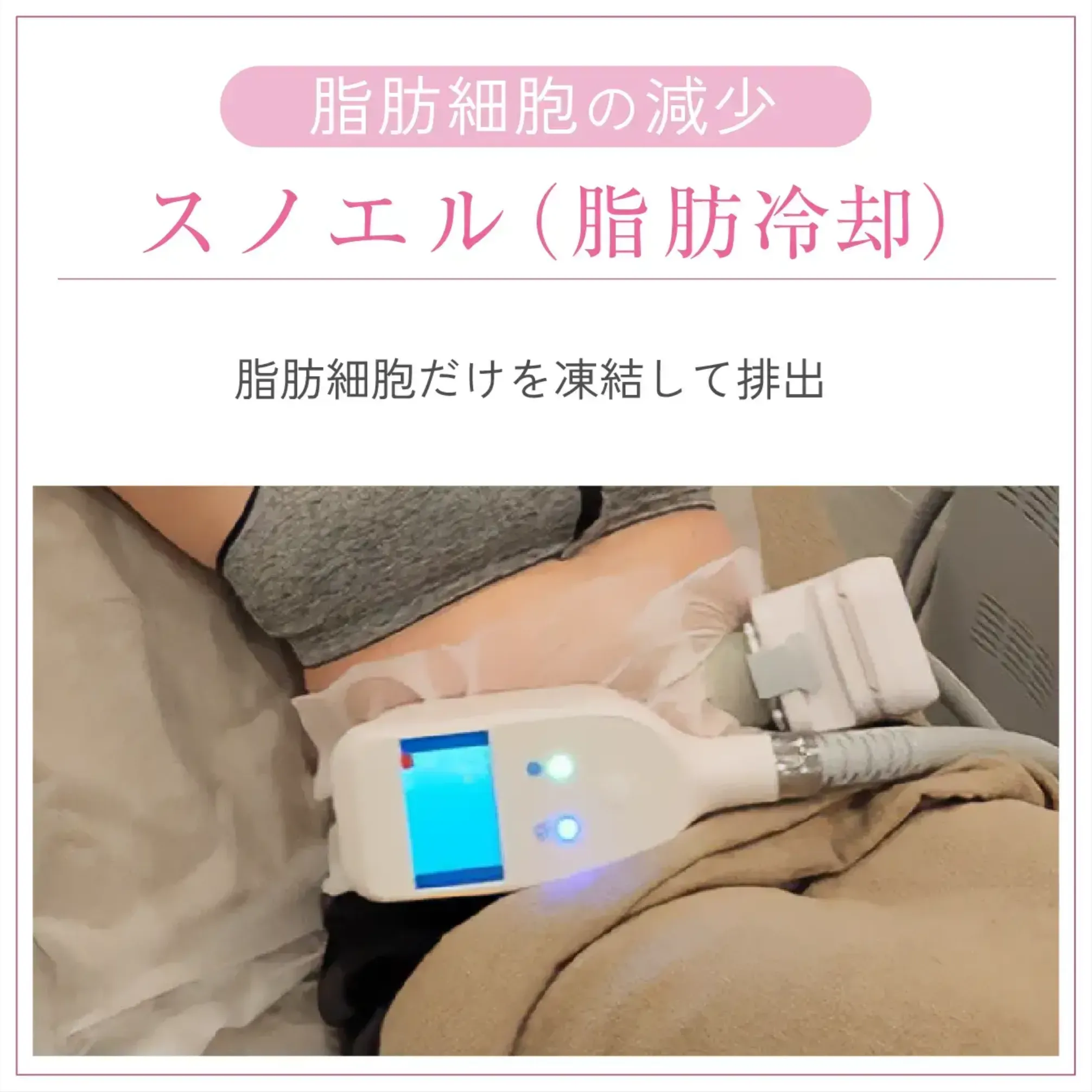 スノエル(脂肪冷却)