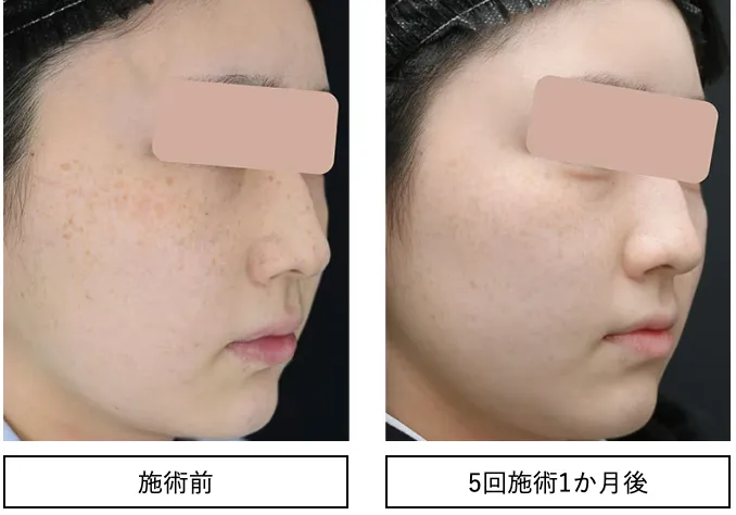 湘南美容クリニックのキャンペーンIPL光治療の症例写真